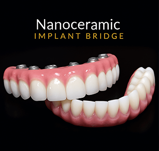 Nanoceramic Implant Bridge